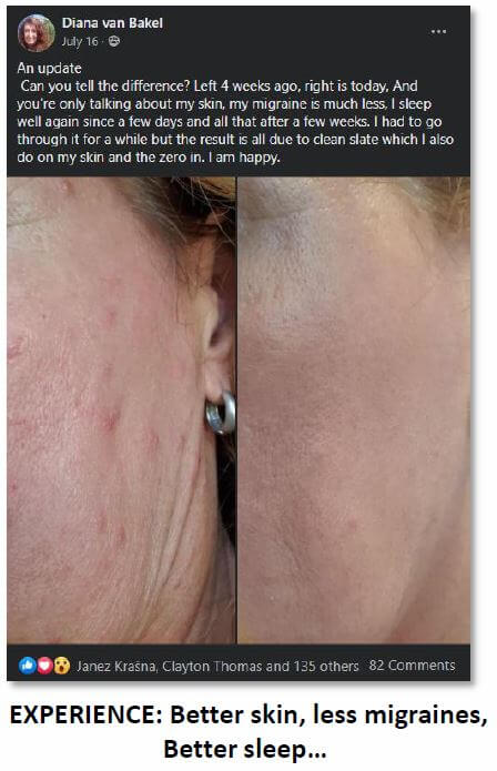 Diana van Bakel's before and after photos showing significant improvement in skin condition after using Clean Slate
