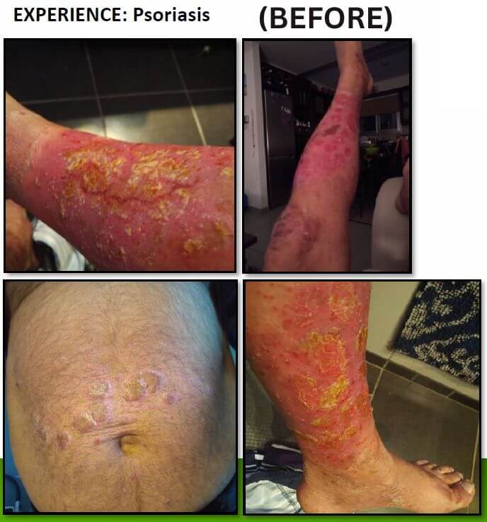 Mark Eddison's severe psoriasis before using Clean Slate, showing inflamed and damaged skin on legs